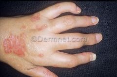 Psoriasis Arthritis