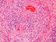 Vasculitis